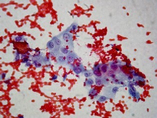 Imagen de Carcinoma Papilar del Tiroides, variante Esclerosante Difusa. Presentacion de un caso