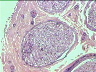 Imagen de Neuropata tomacular. Reporte de un caso