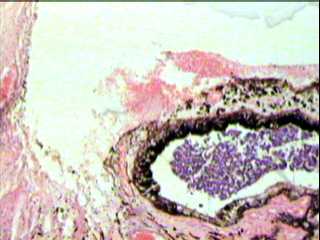 Imagen de Retinoblastoma. Frecuencia y conducta de algunas variables pronosticas en 53 pacientes.  