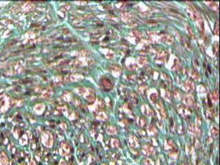 Imagen de Neuropata tomacular. Reporte de un caso