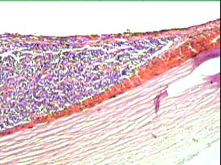 Imagen de Retinoblastoma. Frecuencia y conducta de algunas variables pronosticas en 53 pacientes.  