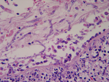 Imagen de Candidiasis sistmica en paciente no inmunodeprimido tras cateterismo cardiaco