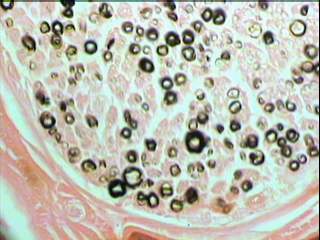 Imagen de Neuropata tomacular. Reporte de un caso