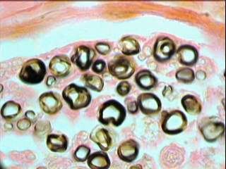Imagen de Neuropata tomacular. Reporte de un caso