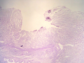 Imagen de Candidiasis sistmica en paciente no inmunodeprimido tras cateterismo cardiaco