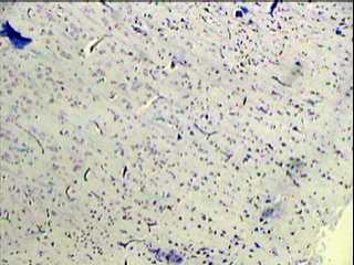 Imagen de Tumor Neuroepitelial Disembrioplstico