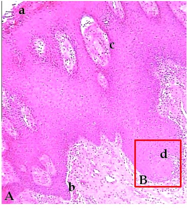 Imagen de Caracterizacin clnico-histopatolgica de la displasia epitelial y expresin de la oncoprotena p53 en la leucoplasia bucal