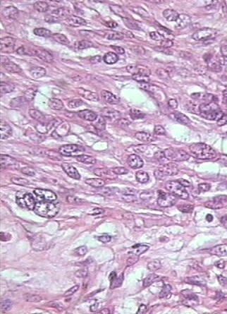 Imagen de Tumor mesenquimatoso del tracto gastrointestinal, variante GILT (Gastrointestinal leiomiomatous tumor). Presentacin de un caso.