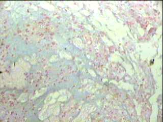 Imagen de Tumor Neuroepitelial Disembrioplstico