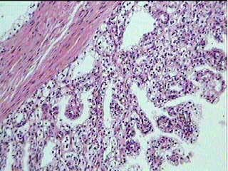 Imagen de Multilocular cystic renal cell carcinoma (MCRCC): A benign tumor entity? Multi-institutional report of 23 cases from Brazil, Spain, Japan, and Argentina.