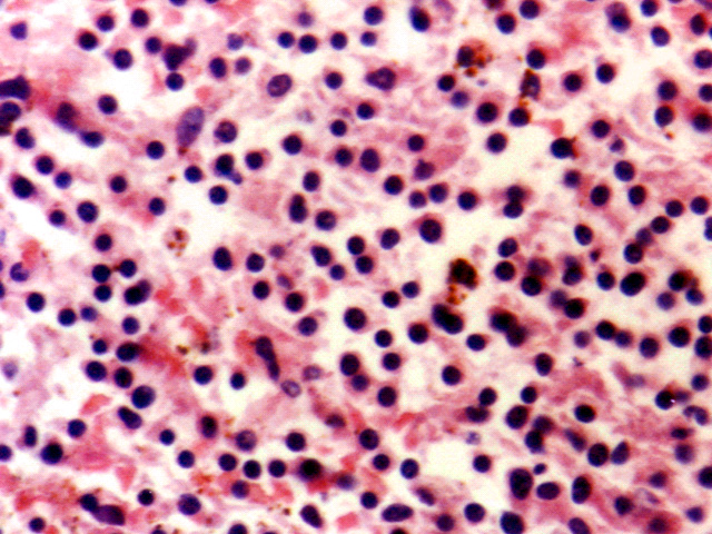 Fig. 26: Linfoma T Hepatoesplnico. - <div style=