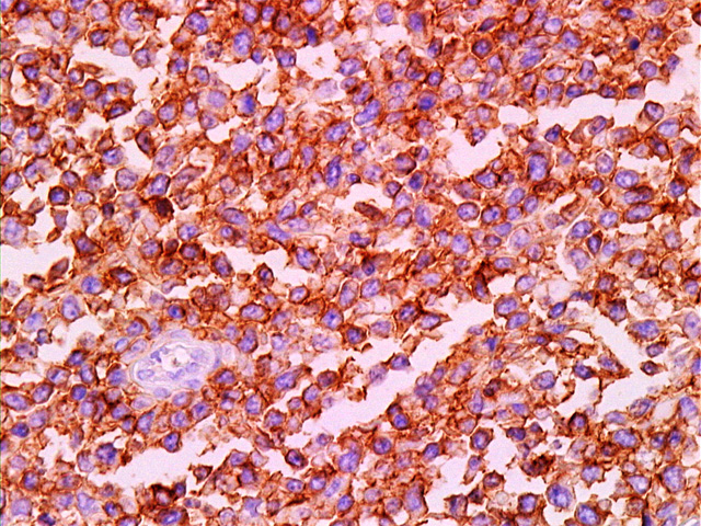 Fig. 18: Linfoma T/NK, tejidos blandos. CD56 - <div style=
