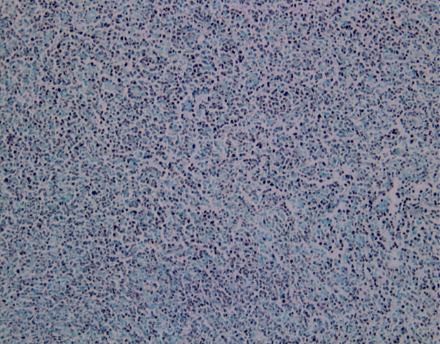Fig. 19: Linfoma T/NK en tejidos blandos. EBER-1 - <div style=