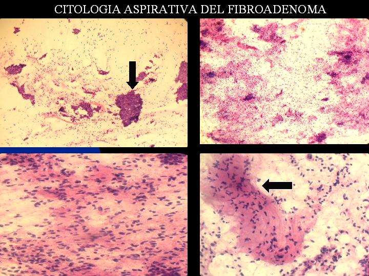 CITOLOGIA ASPIRATIVA DEL FIBROADENOMA - <div style=