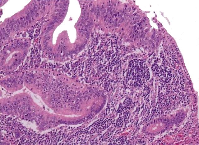 Adenocarcinoma de Yeyuno - <div style=