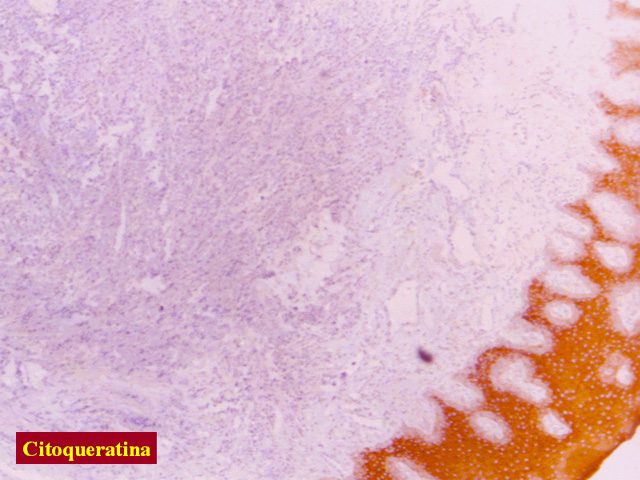 Fig.15: Linfoma Plasmoblastico de la cavidad oral. - <div style=