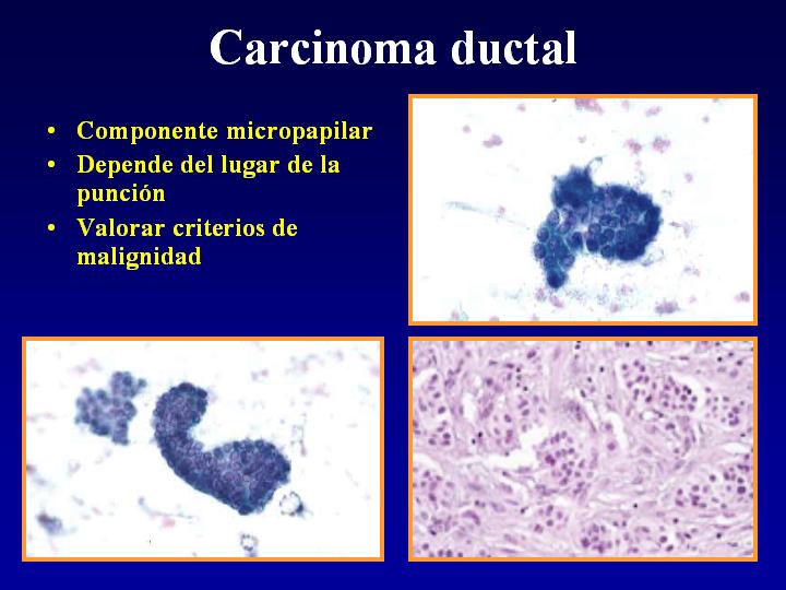 Carcinoma ductal - <div style=