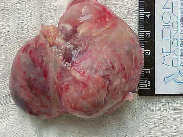 mediastinal mass - <div style=