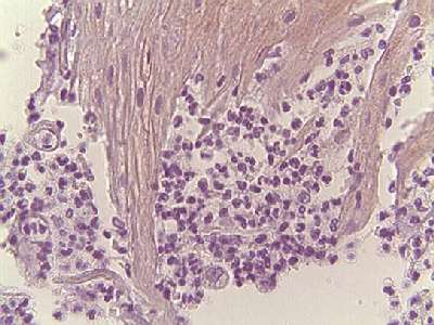 Carcinoma Espinocelular 2 - <div style=