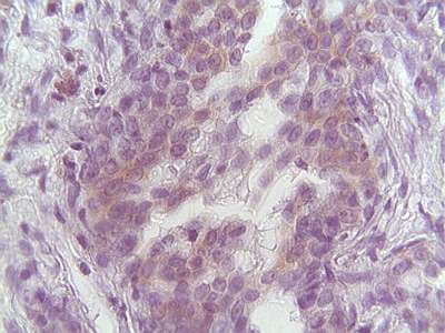 Adenocarcinoma Tubular 2 - <div style=