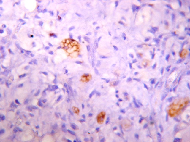 S-100 en phyllodes maligno - Varios lipoblastos teidos por el S 100 rodeados de  fibroblastos malignos
Ocular 10. Obj. 20
Marcador S 100