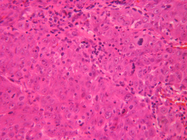 Carcinoma Escamoso - <div style=