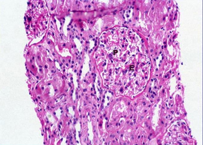 Glomerulonefritis Tipo II B . PAS 200X - <div style=