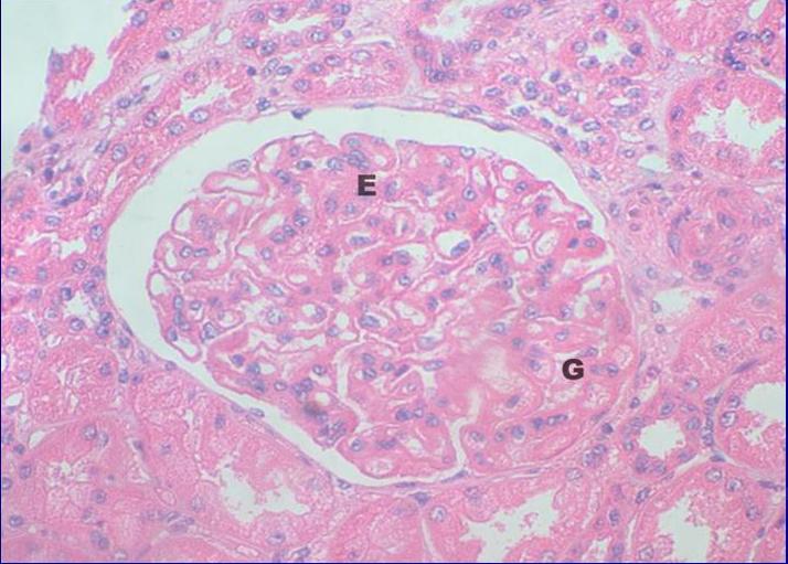 Glomerulonefritis Tipo III A .H-E.400X - <div style=