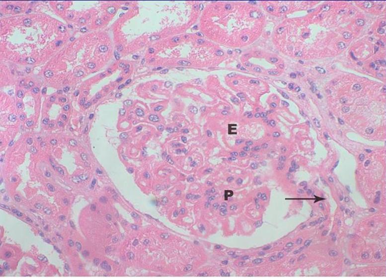 Glomerulonefritis Tipo IIIB. H-E.400X - <div style=