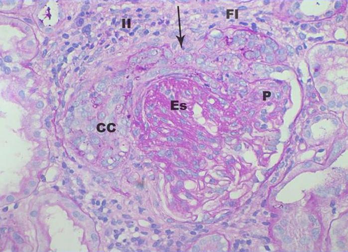 Glomerulonefritis Tipo IVC . PAS 400X - <div style=