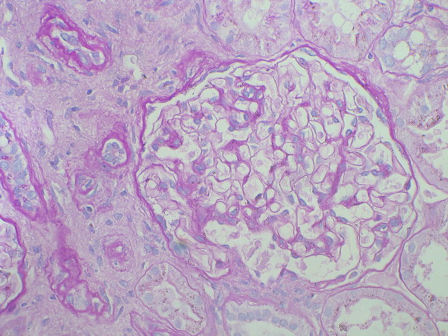 GESF.Atrofia tubular. - Atrofia tubular focal. Un glomrulo donde se aprecia alteraciones de un segmento del mismo(adherencia del penacho a la cpsula).El resto no muestra alteraciones.PAS 400+.