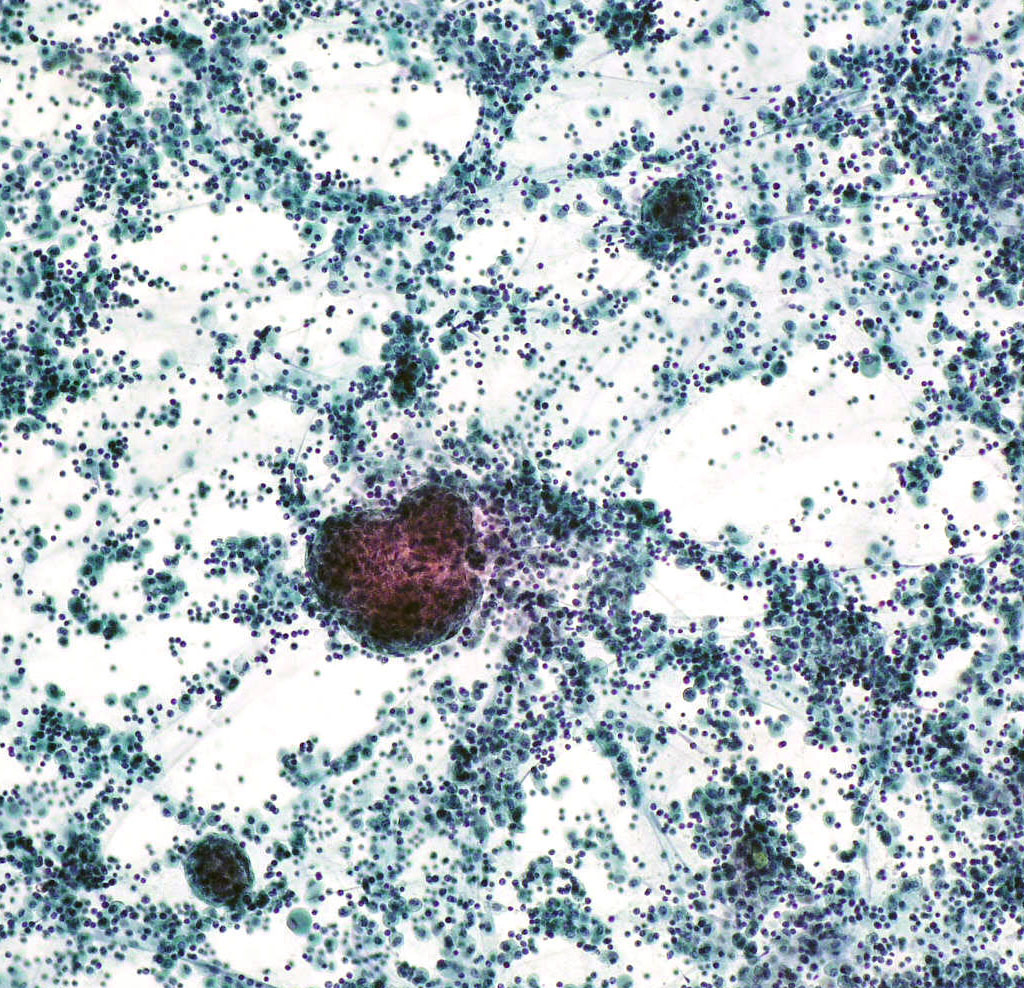 Figura 1 Imagen citologica del liquido pleural con alta celularidad. Abundantes clulas mesoteliales, pocos hemates y grupos celulares (Mrulas) (Papanicolaou,x200)