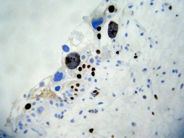 Figura 3 - Inmunotincin nuclear de p53.