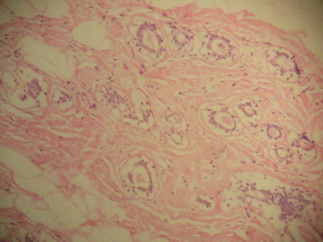 Fig. 2. - Tumor residual pieza de mastectoma. Diferente sector que Fig. 1.