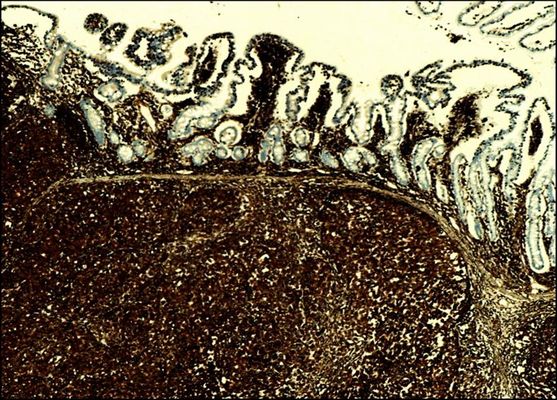 FIGURA 7D - Positividad de la neoplasia para vimentina