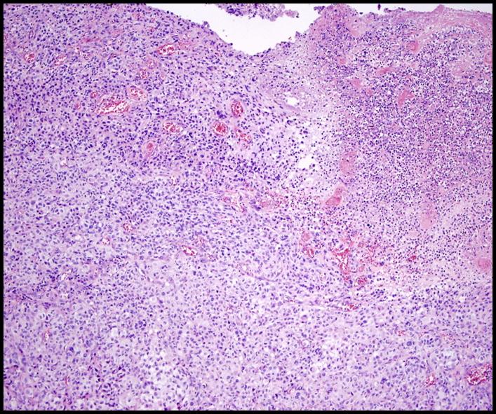 FIGURA 3A - Tincin H-E.(20x).La proliferacin neoplsica esta constituida por clulas de hbito epitelioide, que infiltran en forma de nidos slidos y en forma de pequeas tecas.
