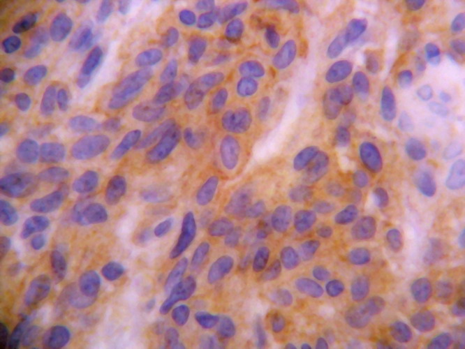 Fig. 9 - MSA tambin es positivo en las clulas neoplasicas perivasculares no fusiformes.