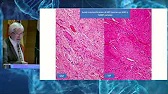 Vdeo Cncer de Vejiga T1. Aspectos anatomopatolgicos recientes y subestadificacion utilizando patologa digital